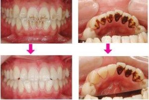 歯の定期的なメンテナンス