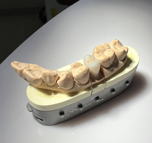 セラミックの硬さの利点、なぜセラミ ックが奥歯に使われるのか。